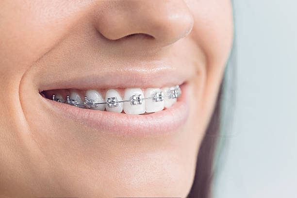 Dental Bonding in Dauphin Island, AL